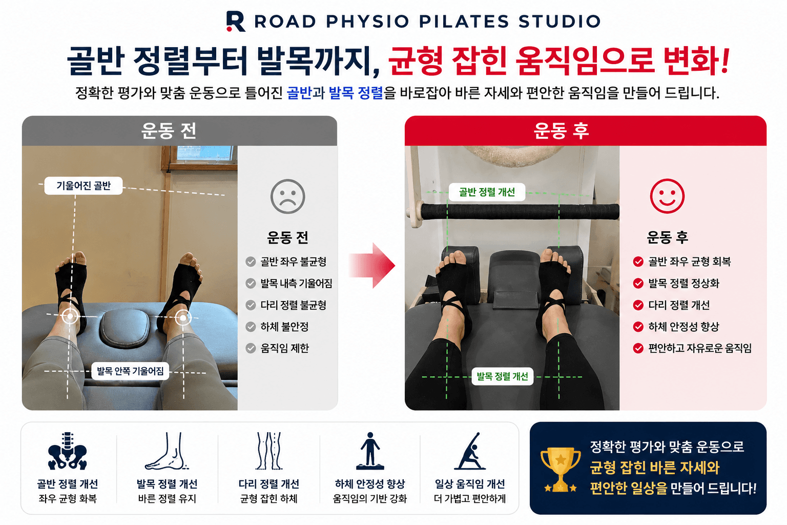 골반·발목 정렬을 통한 균형 개선의 변화 전후 비교